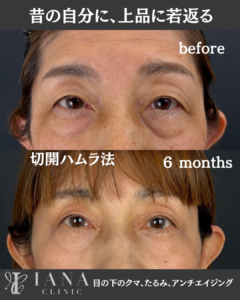 切開ハムラ法 術前術後6ヶ月 比較写真