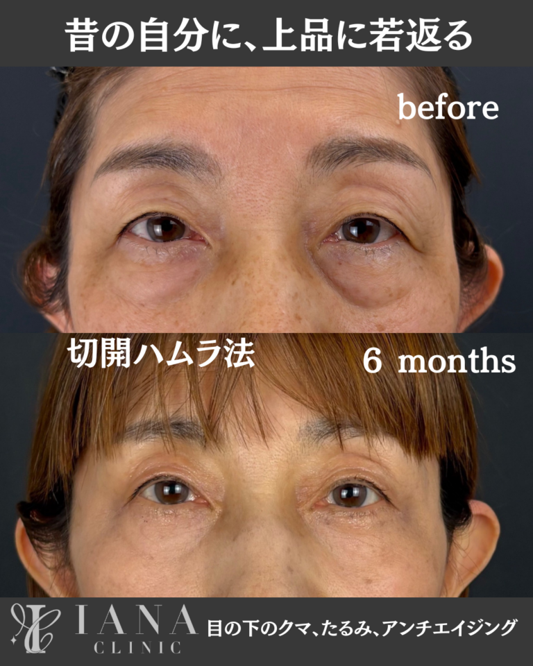 切開ハムラ法 術後6ヶ月の症例①