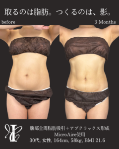 腹部全周脂肪吸引 アブクラックス形成 術前術後3ヶ月 正面比較写真