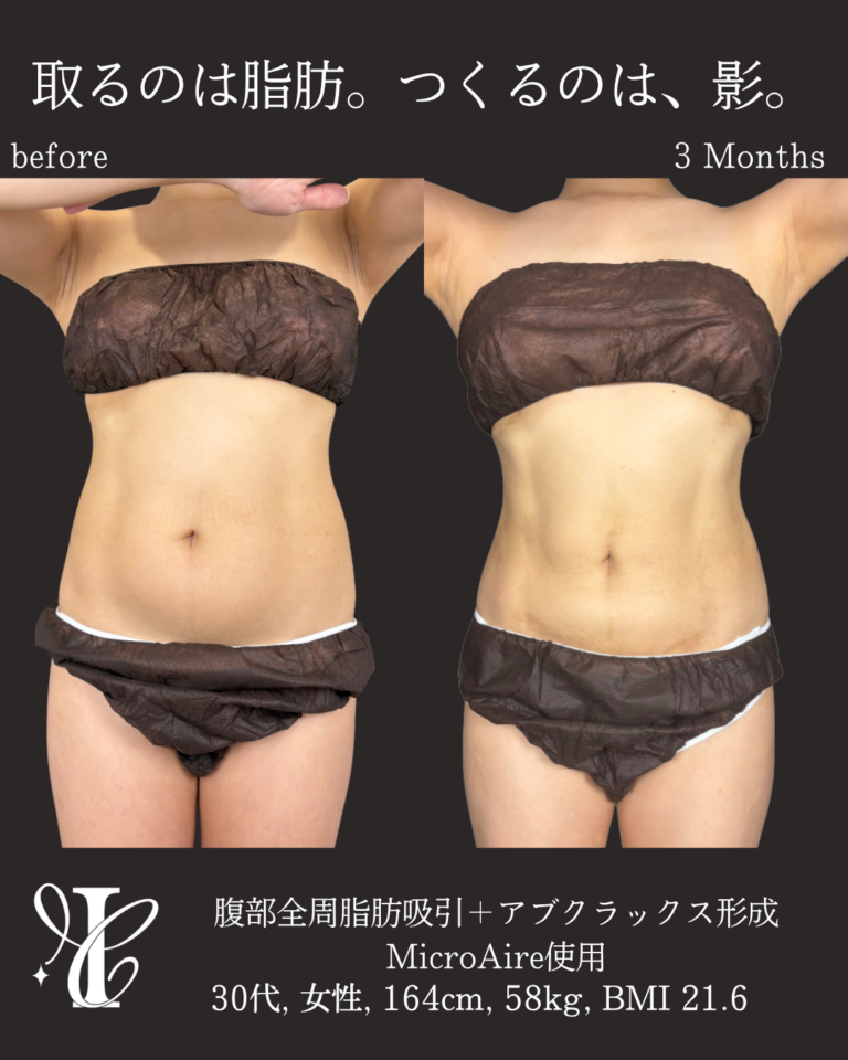 腹部全周脂肪吸引+アブクラックス形成 術後3ヶ月の症例②