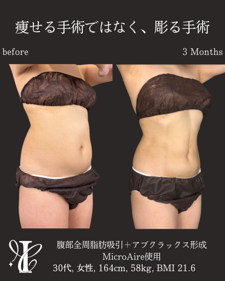 腹部全周脂肪吸引+アブクラックス形成 術後3ヶ月の症例②(斜め)