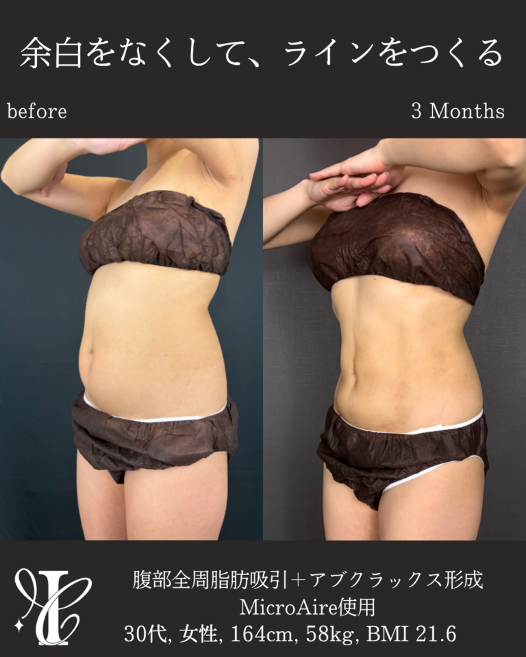 腹部全周脂肪吸引+アブクラックス形成 術後3ヶ月の症例②(斜め・反対側)