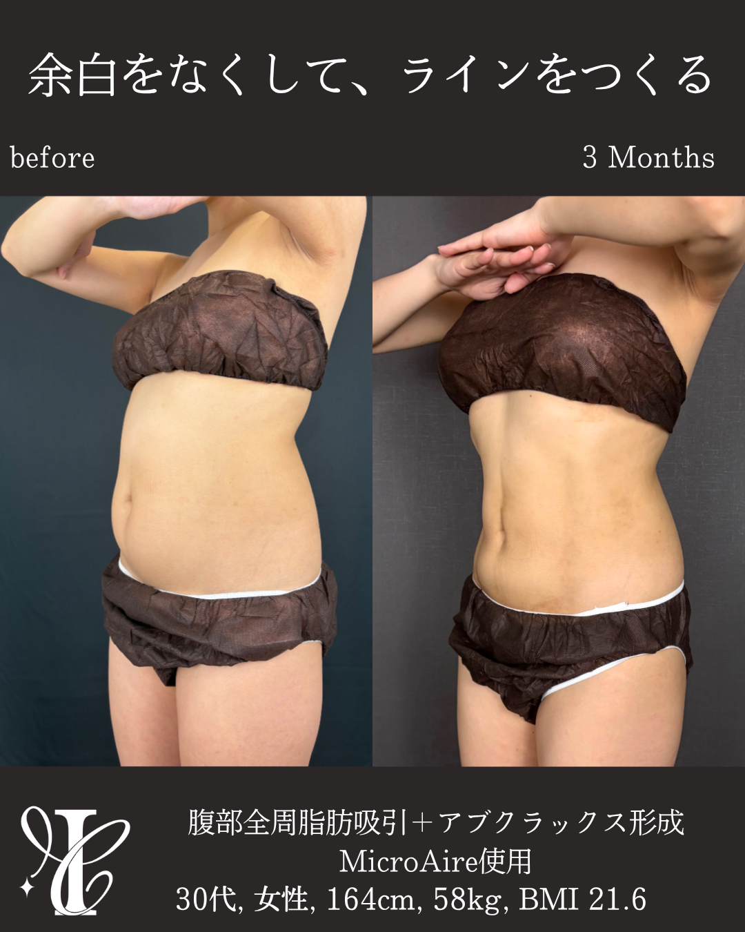 腹部全周脂肪吸引 アブクラックス形成 術前術後3ヶ月 左斜め比較写真