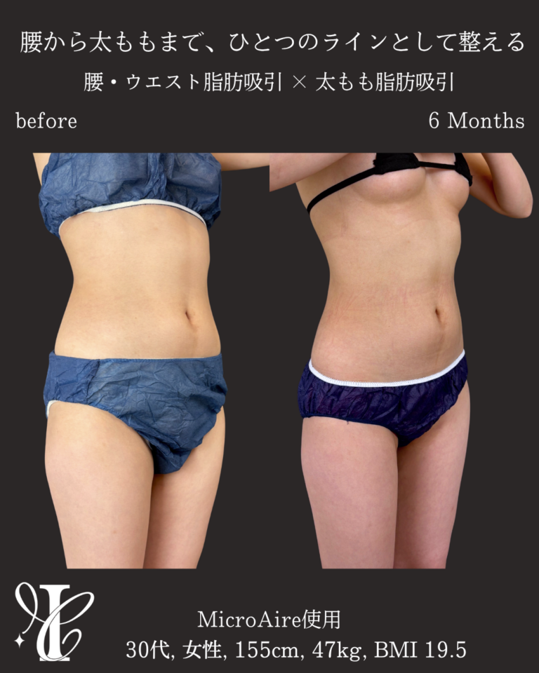 腰・ウエスト+太もも脂肪吸引 術後6ヶ月の症例①(前面・別アングル)