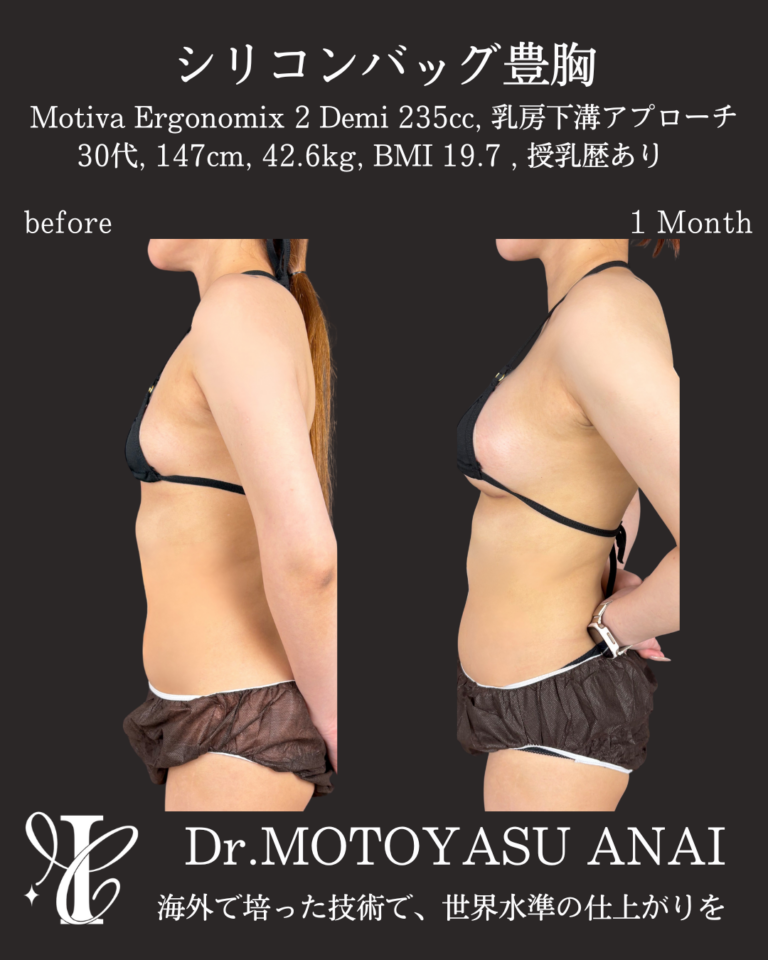 シリコンバッグ豊胸(Motiva Demi 235cc) 術後1ヶ月の症例③(側面)