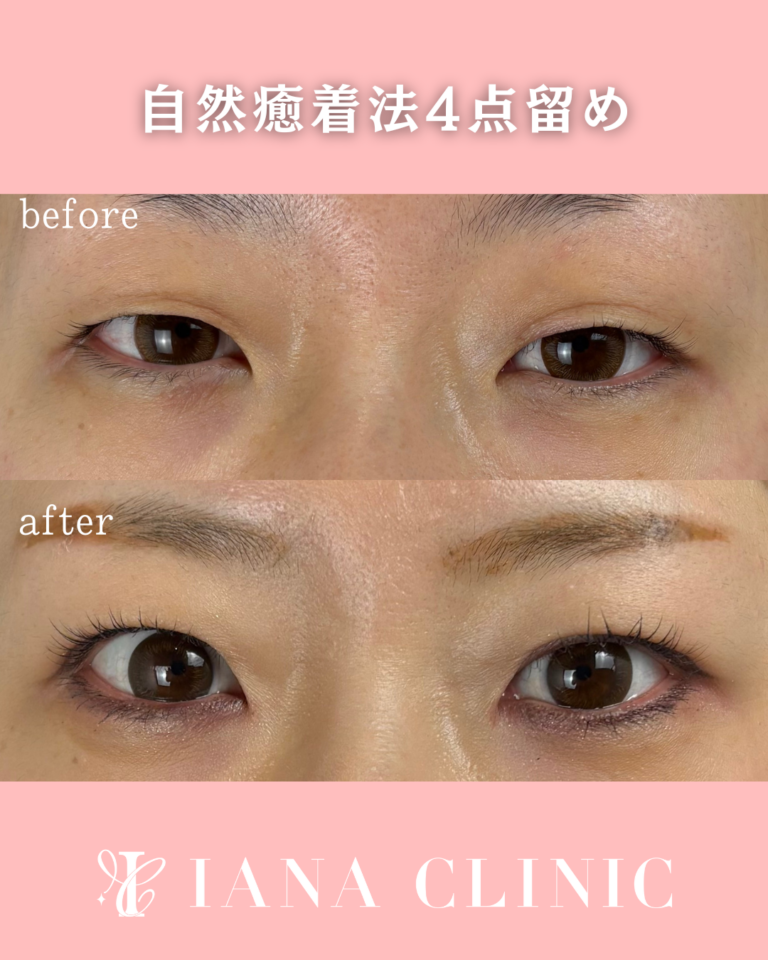 二重埋没法(自然癒着法)4点留め 術直後の症例⑦