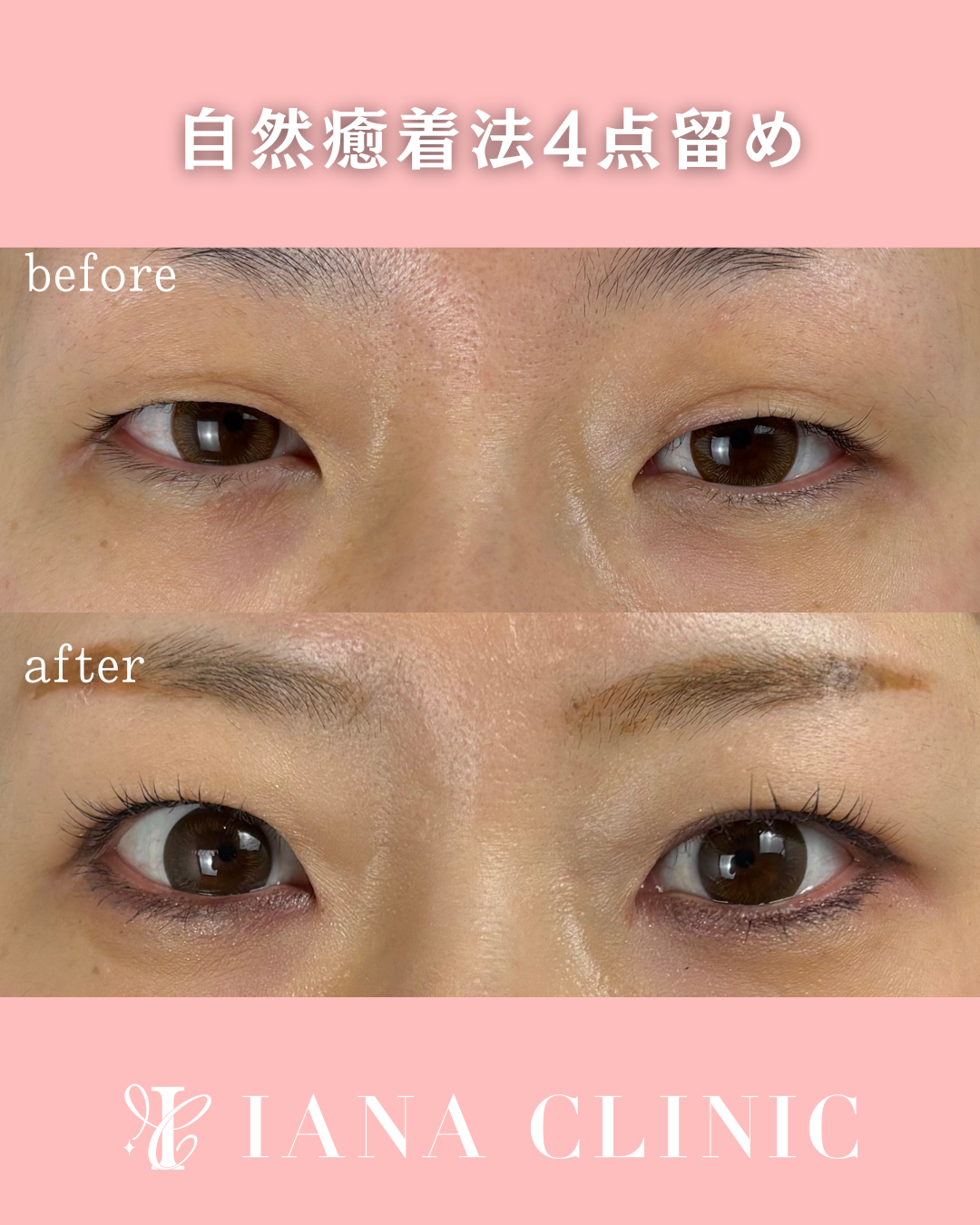 二重埋没法(自然癒着法)4点留め 術前術後1ヶ月 比較写真