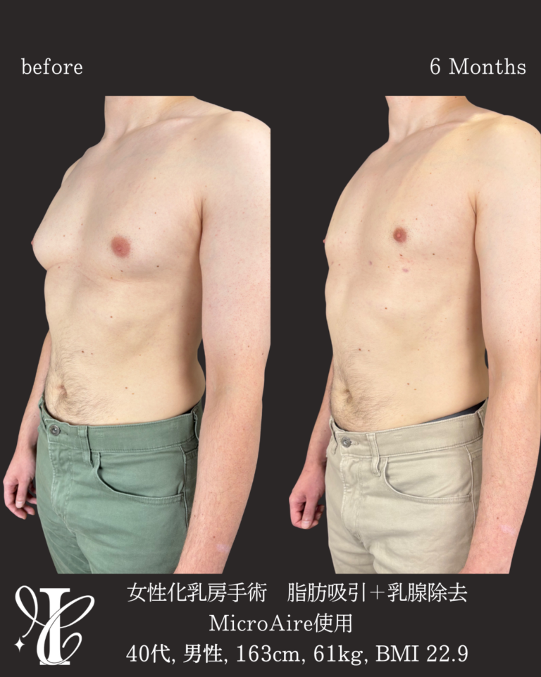 女性化乳房手術（脂肪吸引＋乳腺除去）術後6ヶ月の症例