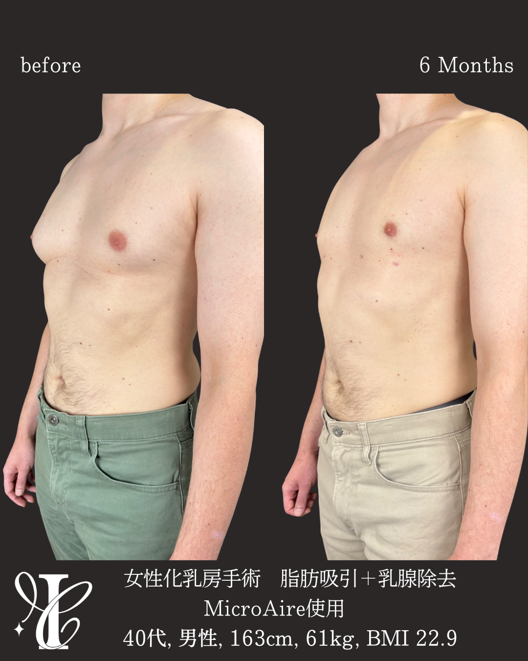 女性化乳房手術 脂肪吸引+乳腺除去 術前術後6ヶ月 左斜め前比較