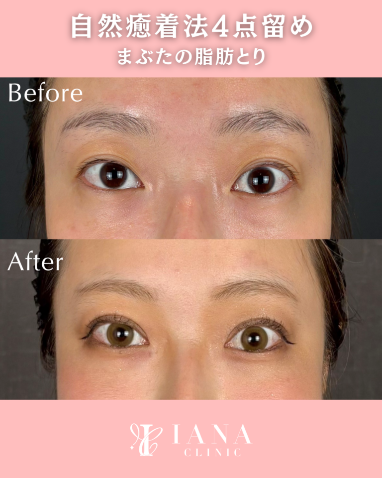二重埋没法(自然癒着法)4点留め 術後3ヶ月の症例⑤
