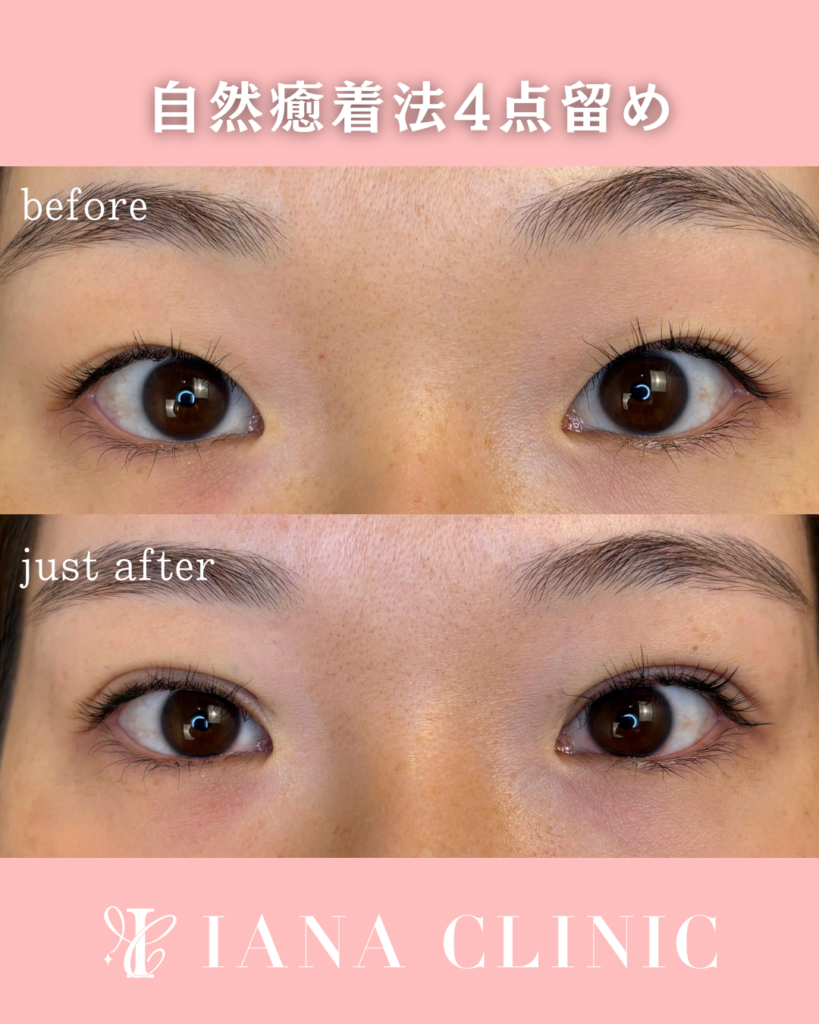 二重埋没法(自然癒着法)4点留め 術前術直後 比較写真