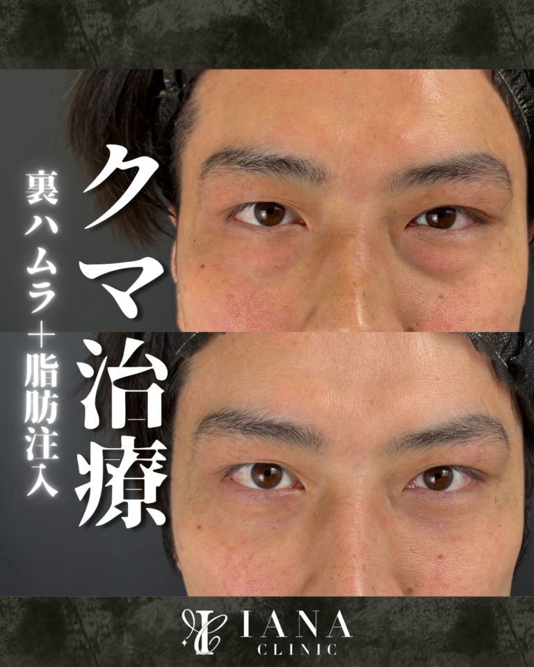 裏ハムラ法＋脂肪注入（目の下） 術後6ヶ月の症例①