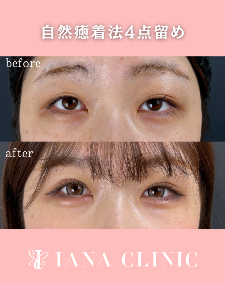 二重埋没法(自然癒着法)4点留め 術後1ヶ月の症例①