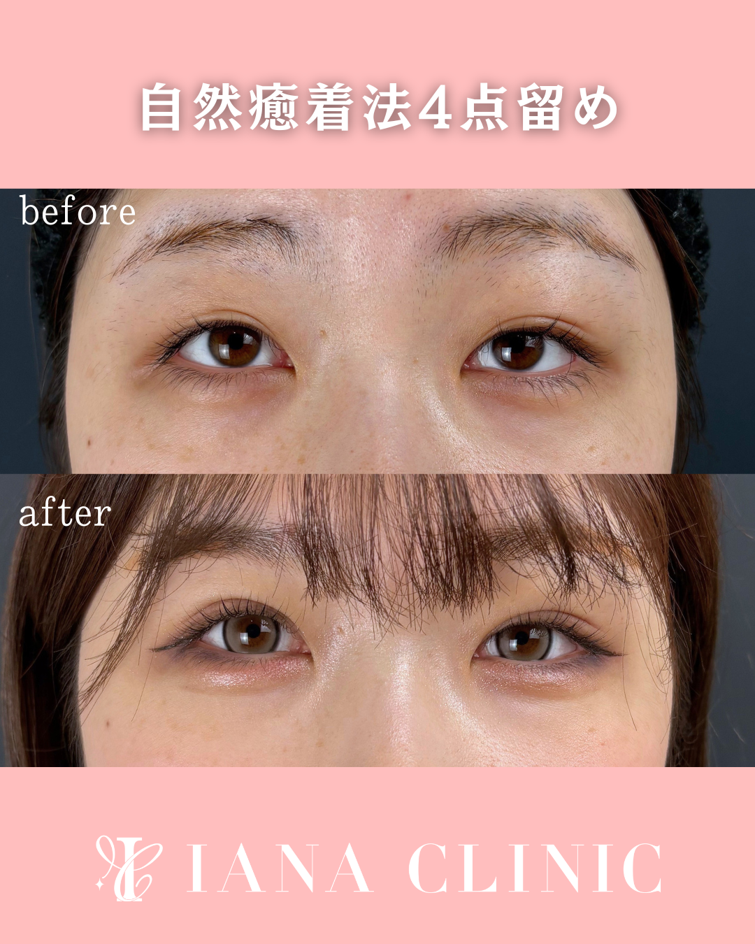 二重埋没法4点留め 術前術後1ヶ月 比較写真