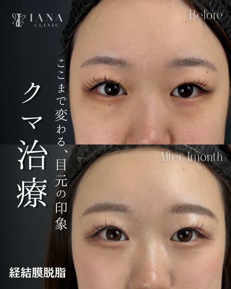 経結膜脱脂 術後1ヶ月の症例④