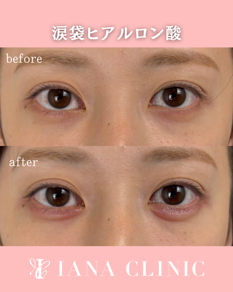 涙袋ヒアルロン酸 術前術後比較写真