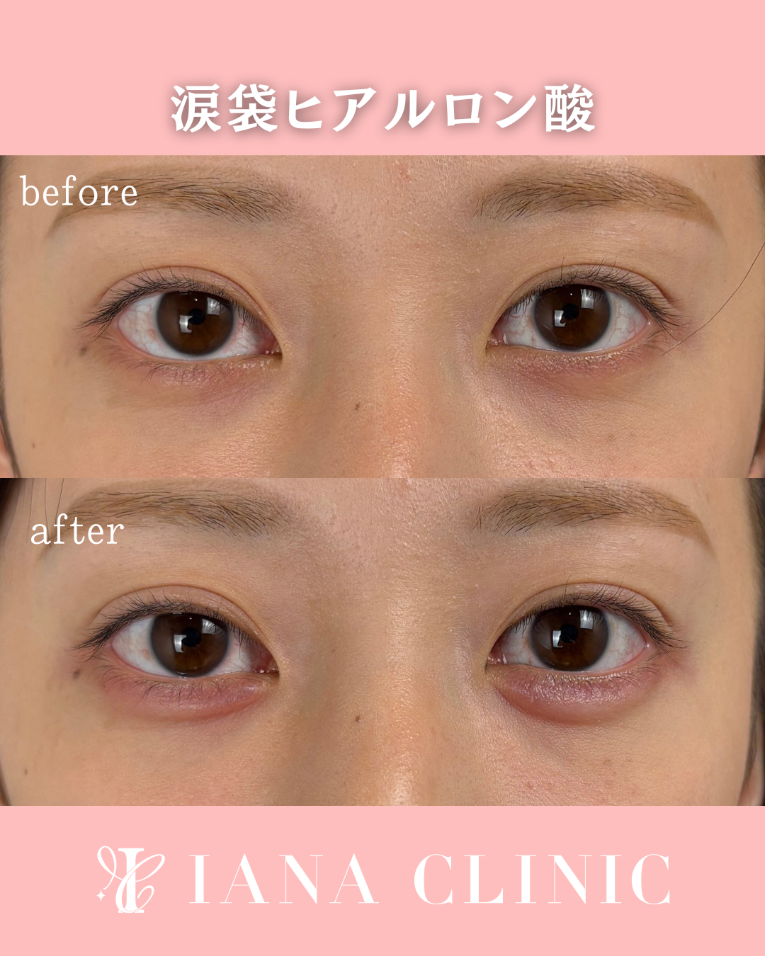 涙袋ヒアルロン酸 術前術後比較写真