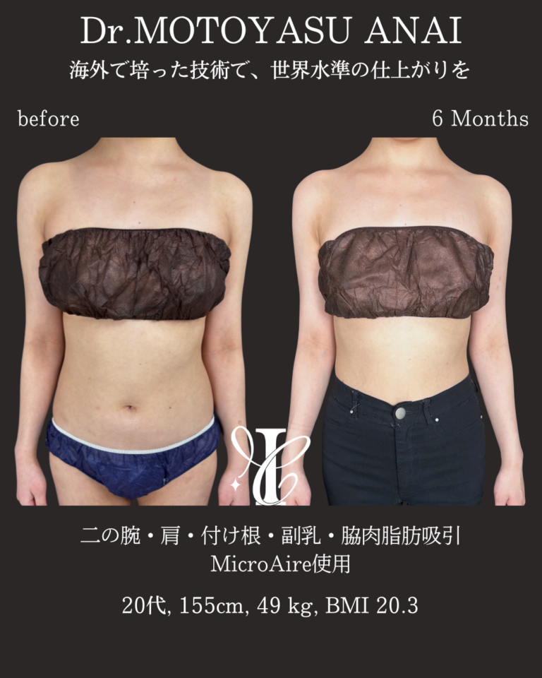 二の腕・肩・付け根+副乳・脇肉脂肪吸引 術後6ヶ月の症例①